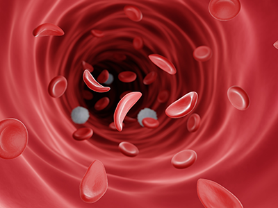Normal red blood cell and sickle cell flow inside in artery.