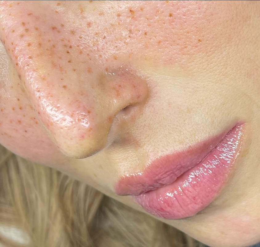 Close-up of a person's face showing freckles on the nose and cheeks, with pink lips and smooth skin.