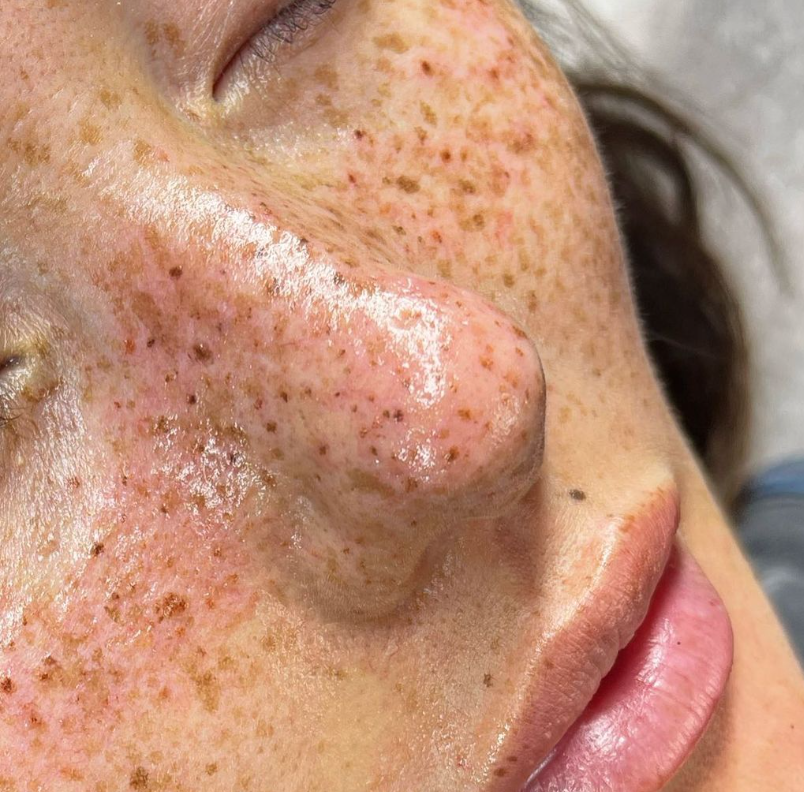 Close-up of a person's face showing freckles, with a focus on the nose and lips.