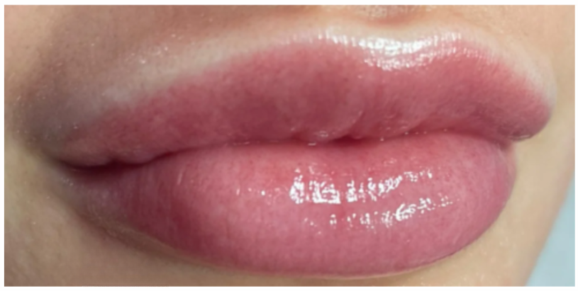 Lip Rejuvenation + Color Restoration