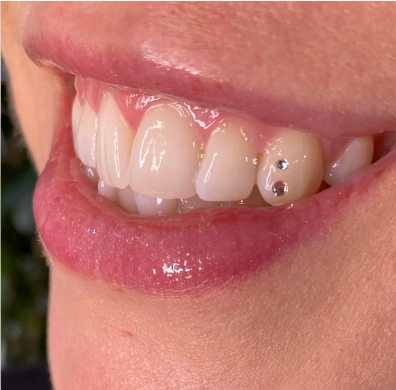 Close-up of a person's mouth showing upper teeth with a small dark filling or cavity on one tooth.