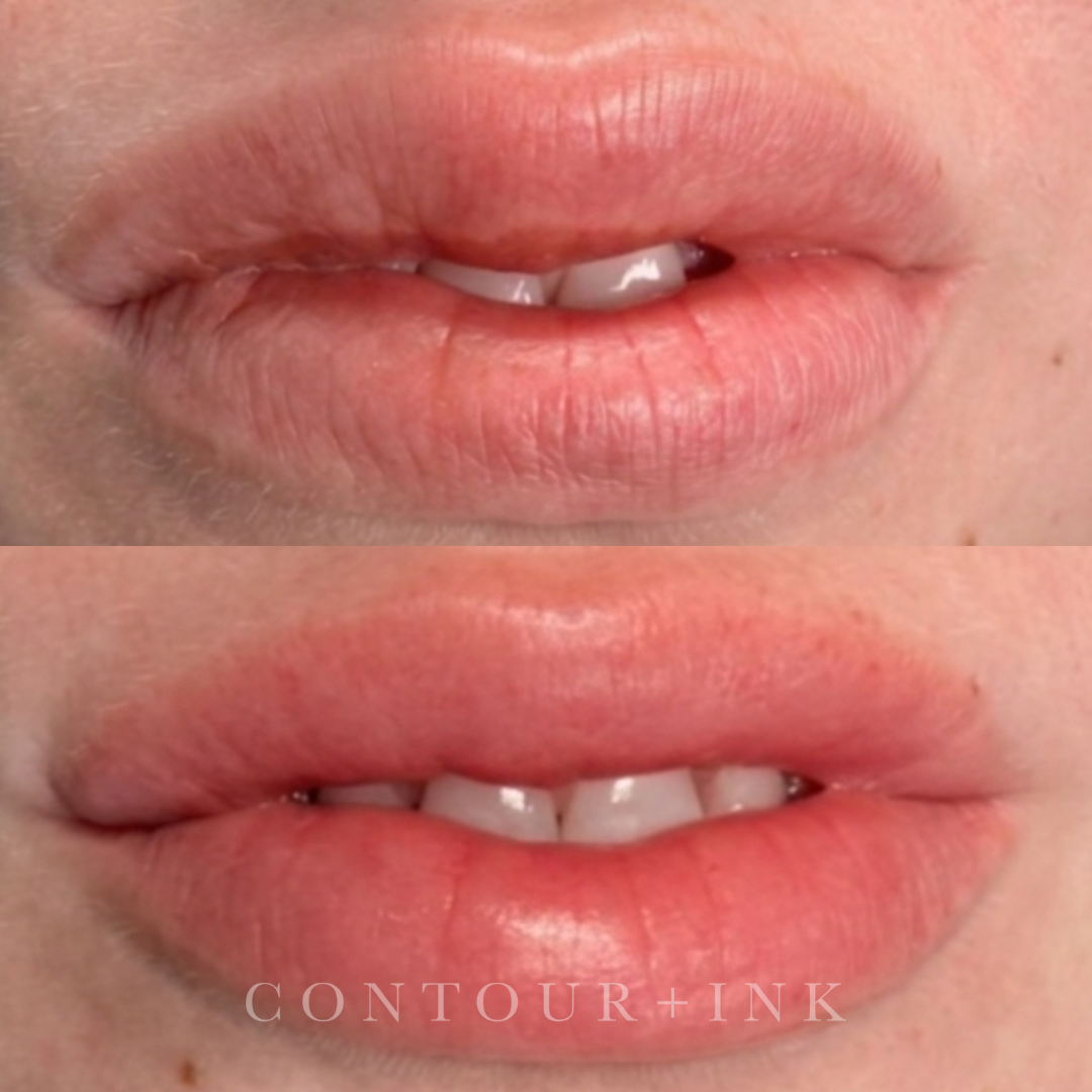 Close-up of lips, teeth with clear dental braces, and part of the nose.