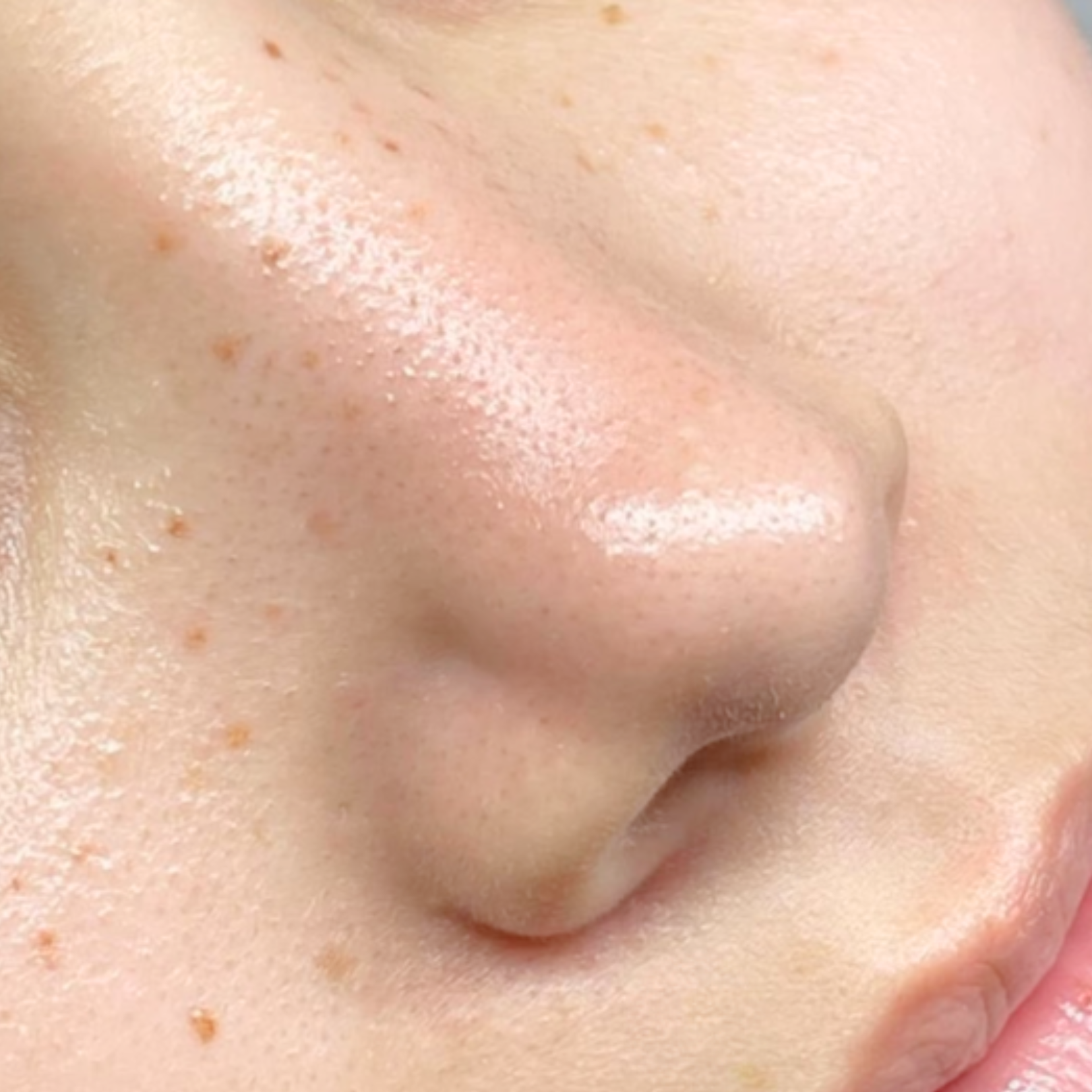 Close-up of a person's nose with blackheads and skin with acne scars.