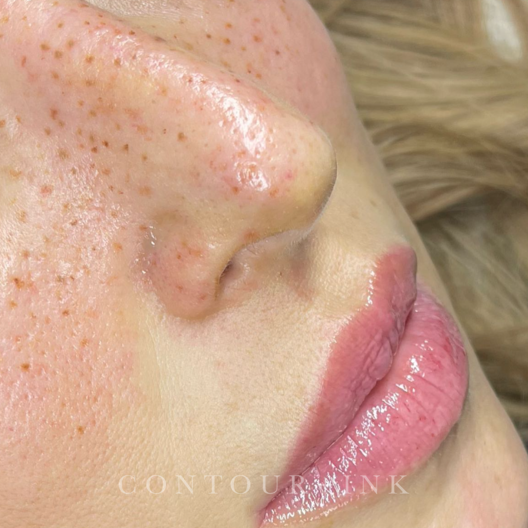 Close-up of a person's face with visible pimples, blackheads, and slightly oily skin, focusing on the area around the nose and lips.