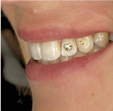 Close-up of a person's smile showing teeth with gold heart-shaped dental jewelry on the front teeth.