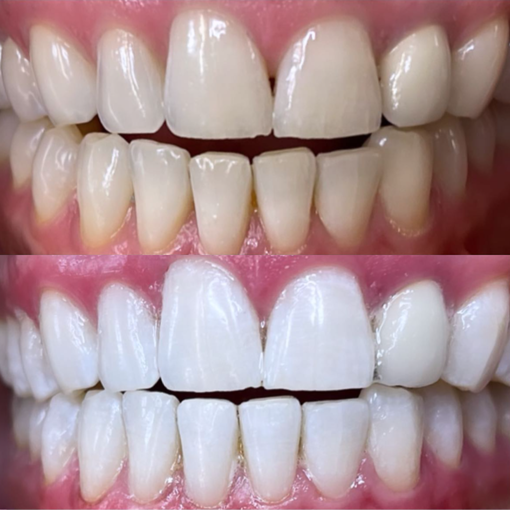 Teeth Whitening Before and After.png
