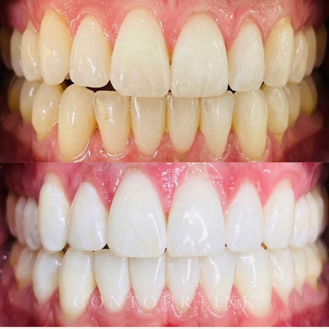Close-up images of teeth before and after dental whitening treatment, showing brighter and whiter smile in the second image.