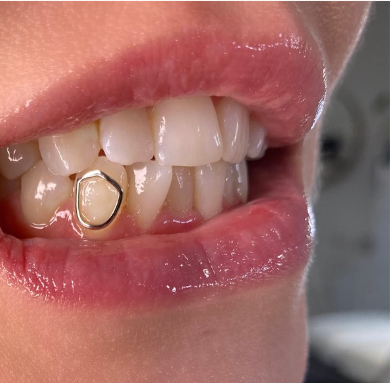 Close-up of a person's mouth showing a gold tooth cap on the lower left molar.