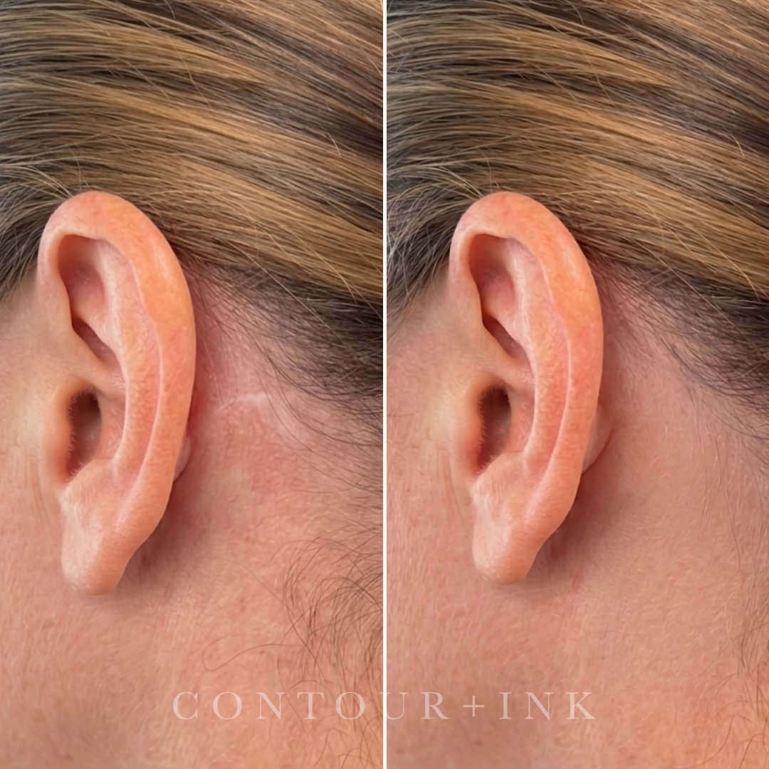A side-by-side comparison showing a close-up of skin with some skin imperfections.