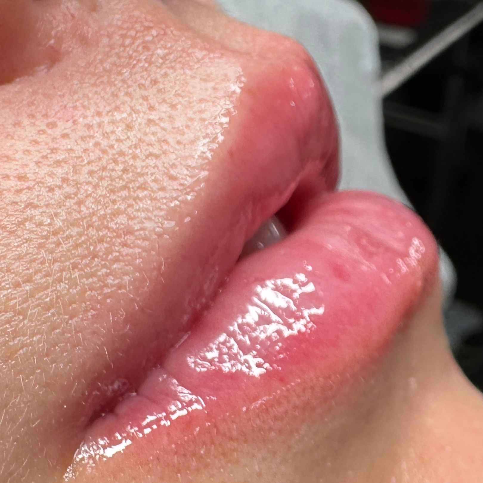 Precision Lip Renewal Before and After.png