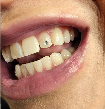 Close-up of a smiling person's open mouth showing teeth, some with dental fillings or annotations.