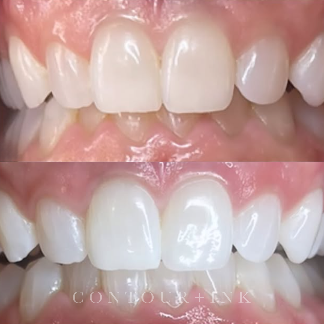 Close-up of a person's lips and teeth, showing the upper teeth with visible gums and pink lips with natural texture.