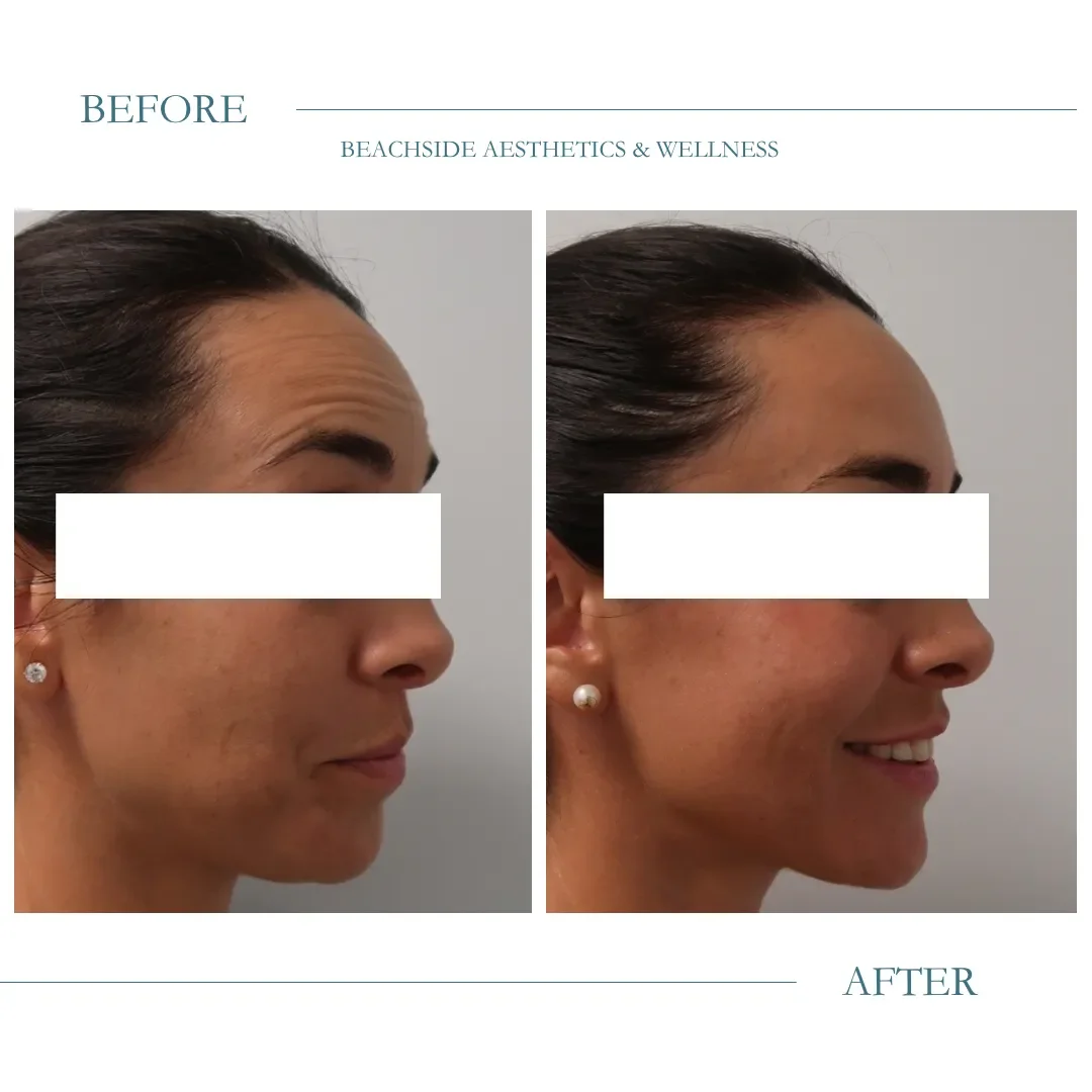 botox-before-after-honolulu-1.webp