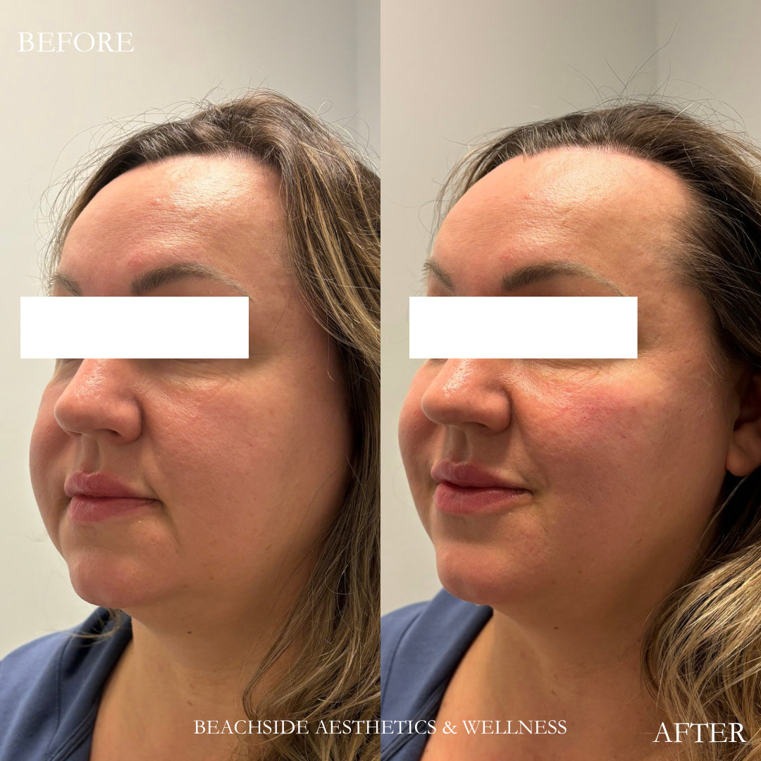 Before and After result of Cheek Filler in Honolulu, Hawaii. 