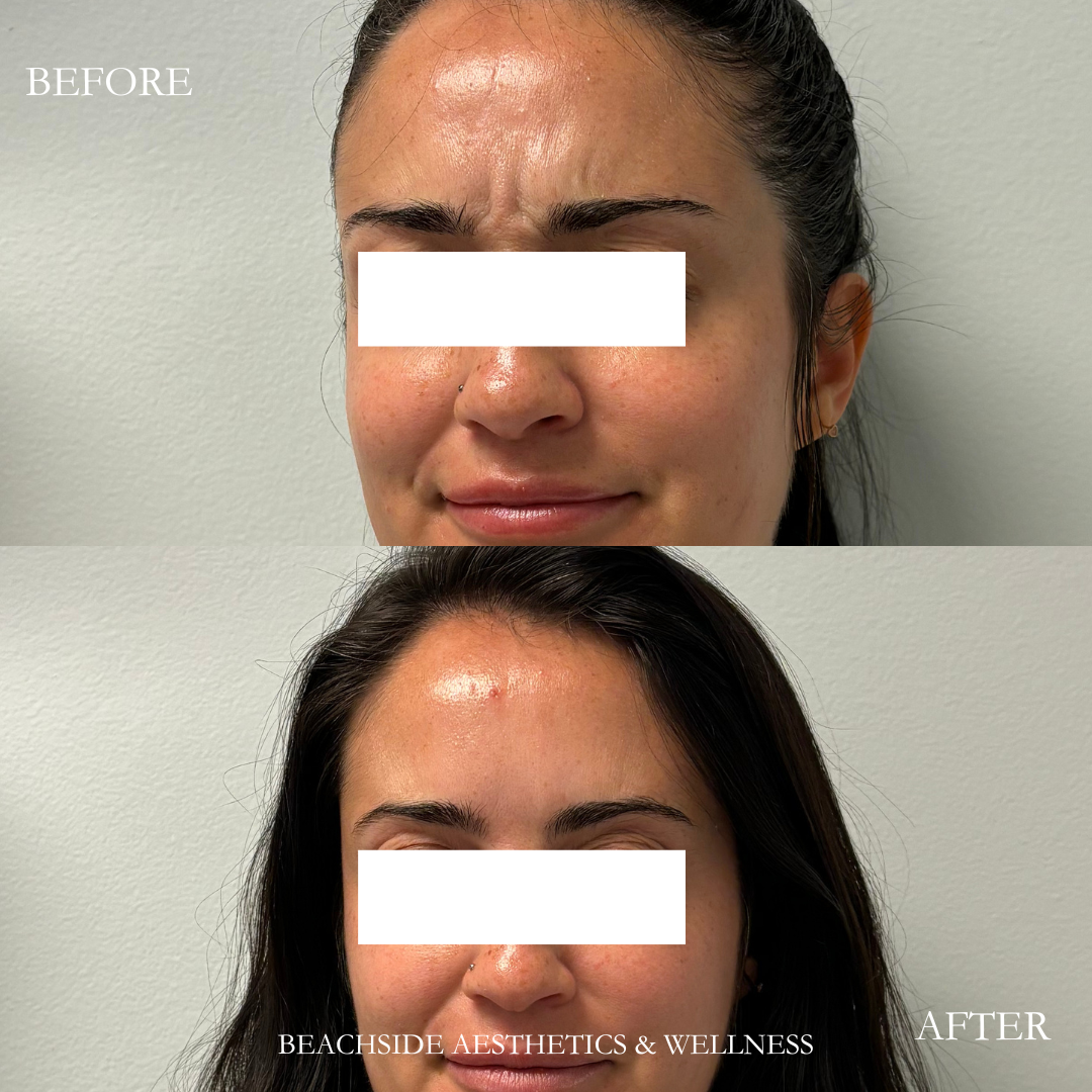 Botox for eleven lines in Honolulu