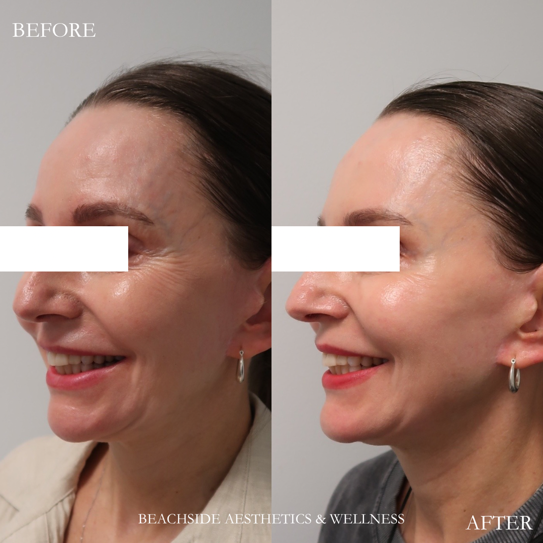 Before and After results of wrinkle treatment of crows feet using Jeuveau "New Tox" in Honolulu. Cheap alternative to botox in Honolulu. 