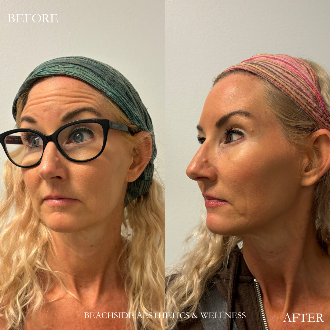 Patient results showing great results from treatment of botox for forehead lines at Beachside Aesthetics and Wellness in Honolulu
