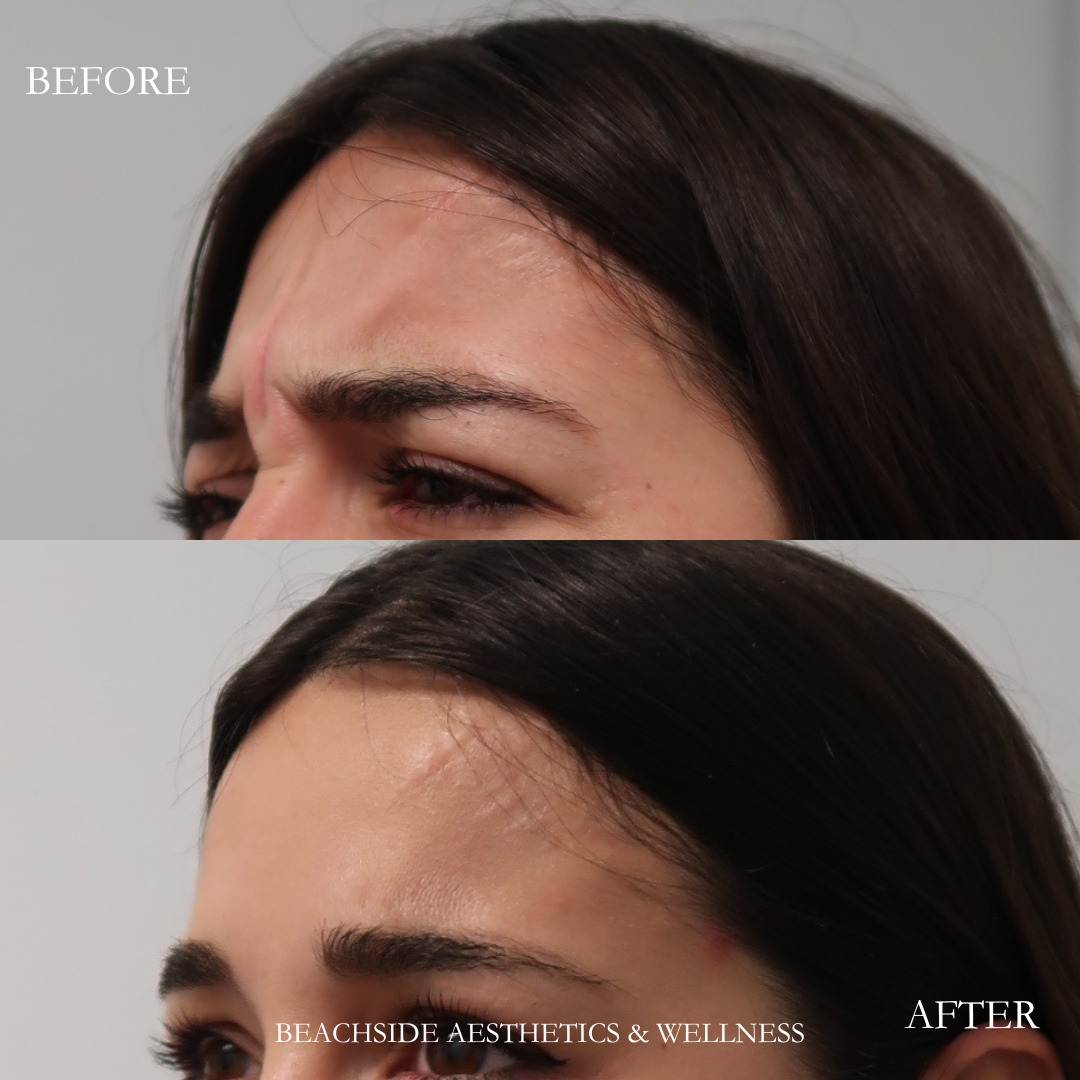 Photo showing natural results from botox treatment in Honolulu by skilled injector. 