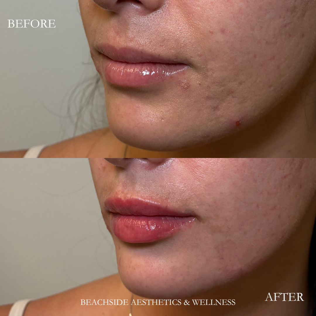 Natural Lip Filler results in Honolulu, Hawaii at Beachside aesthetics and wellness. Photo showing natural lip filler treatment in Honolulu. 