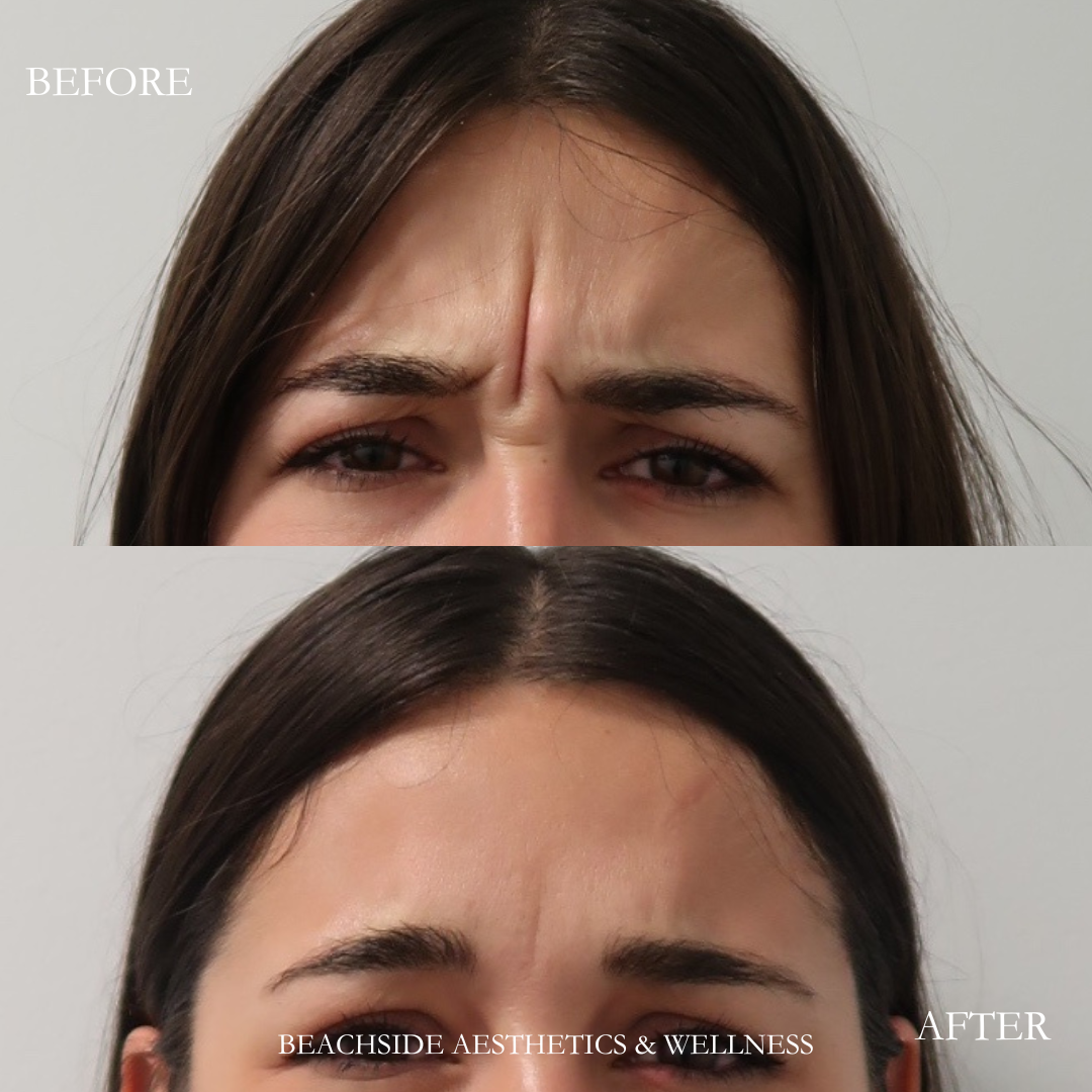 best treatment for elevens using botox in Honolulu