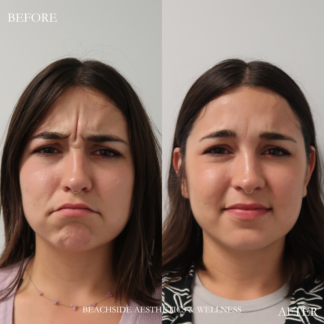 Botox results from treatment of frown lines in Honolulu at Beachside Aesthetics and Wellness. 