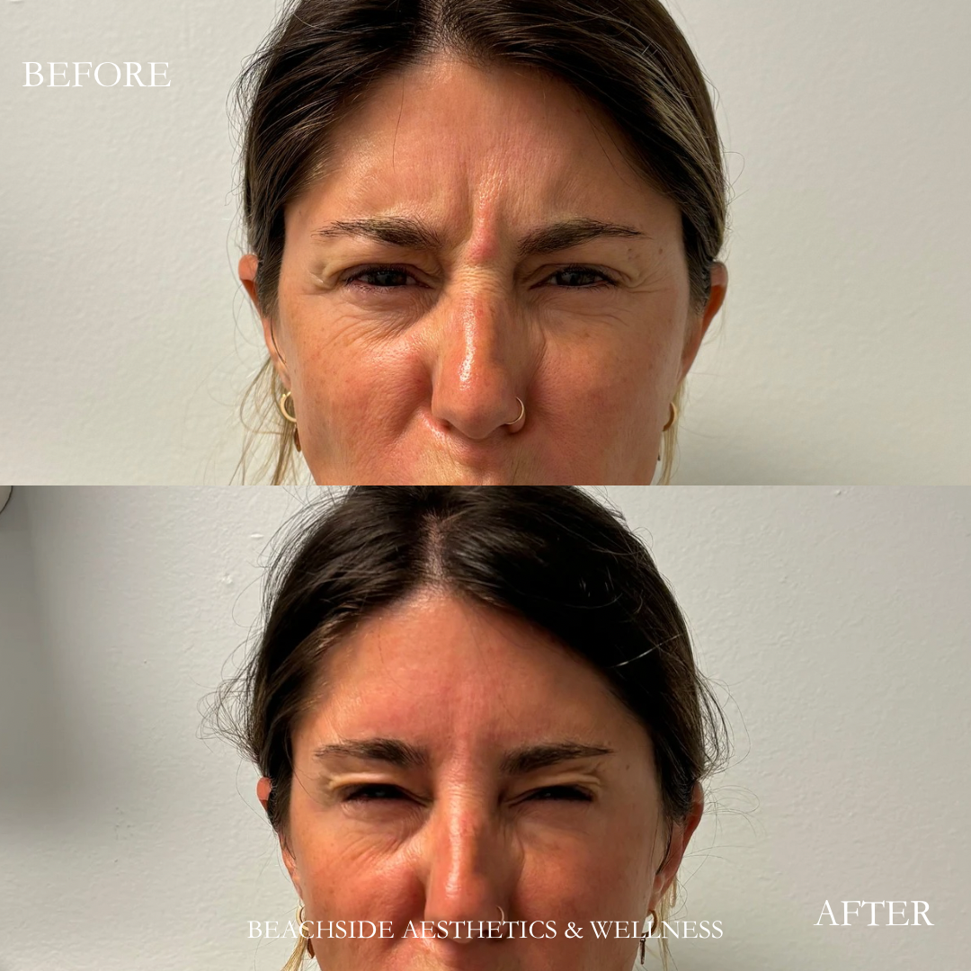 Before and After treatment of botox for elevens in Honolulu