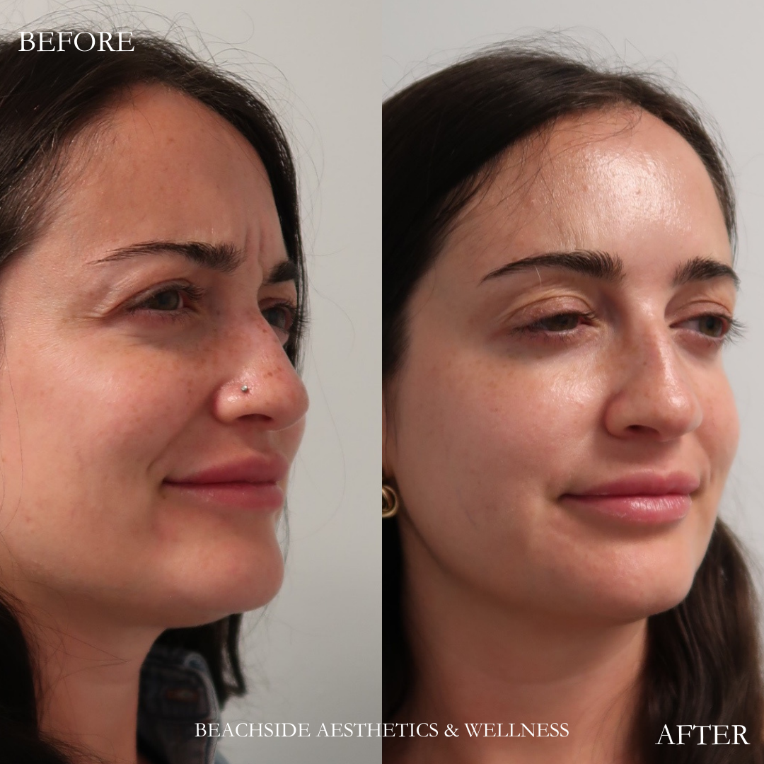 Botox treatment for frown lines and chin dimpling in Honolulu. 