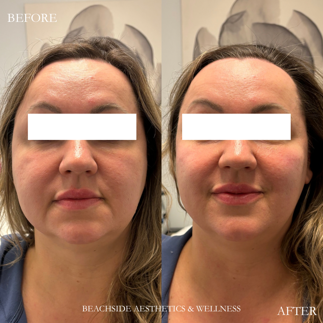 Before and After results of facial balancing in Honolulu at Beachside Aesthetics and Wellness. Cheek Filler Results. 