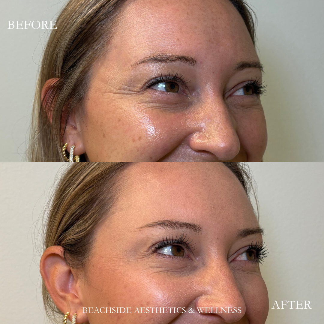Before and After results of patient who received botox to crows feet at Beachside Aesthetics and Wellness in Honolulu, Hawaii.