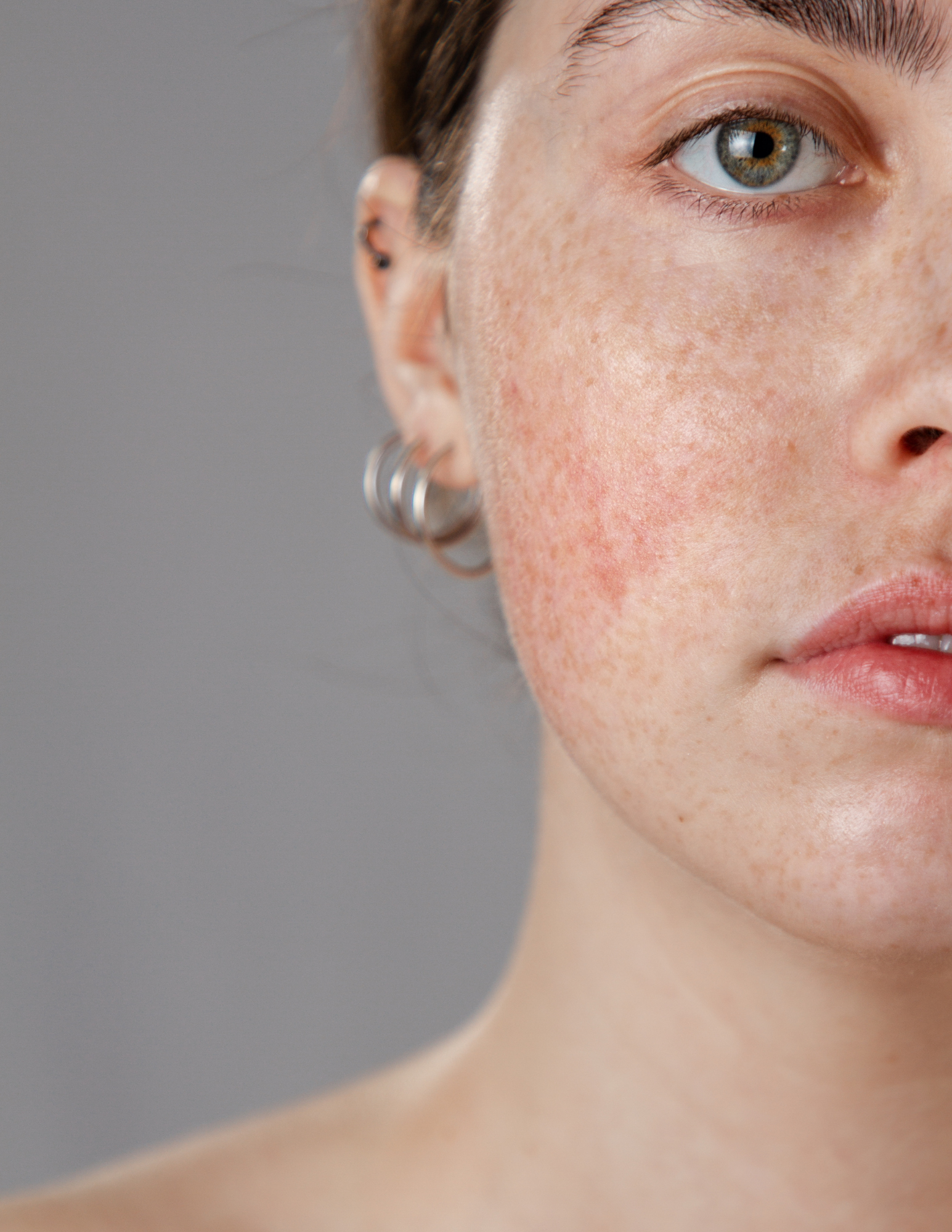 Clinical eczema care