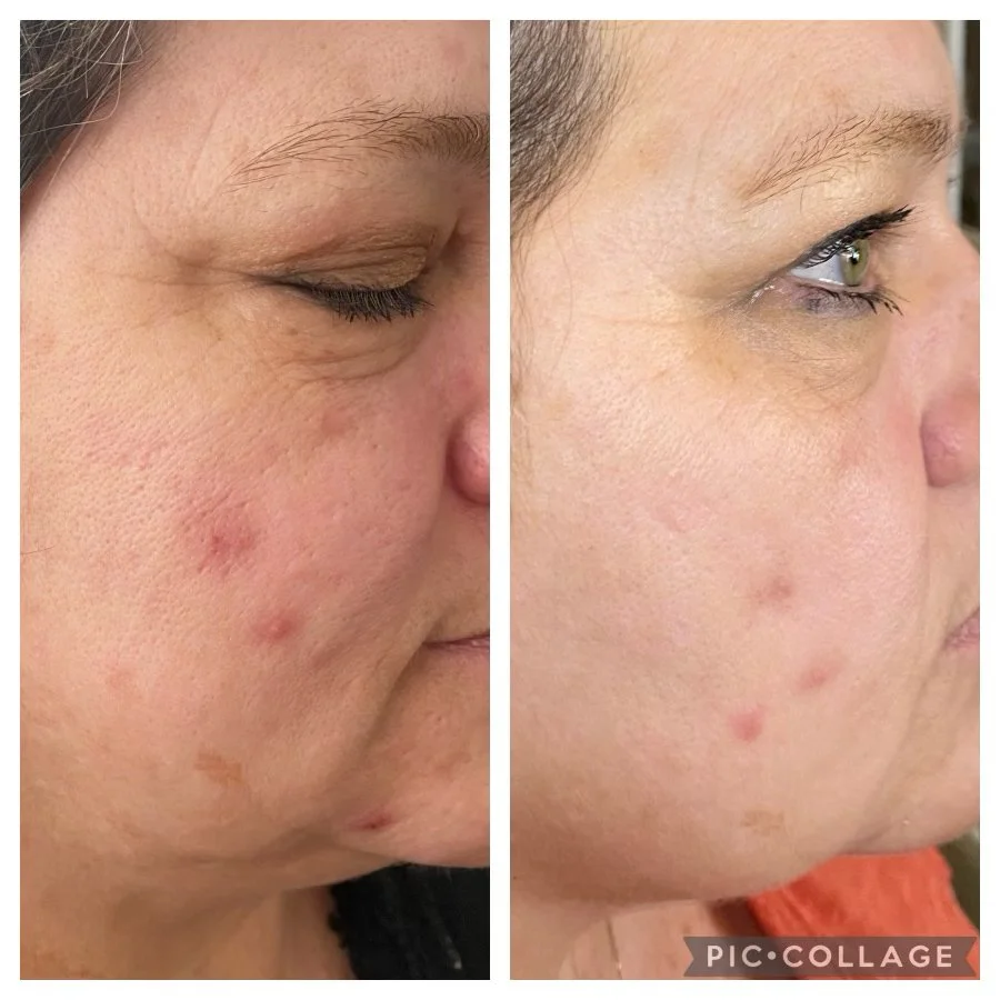 microneedling.jpg