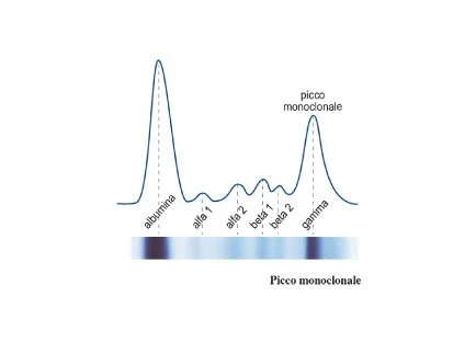 Gammopatia Monoclonale di Significato Incerto (MGUS)