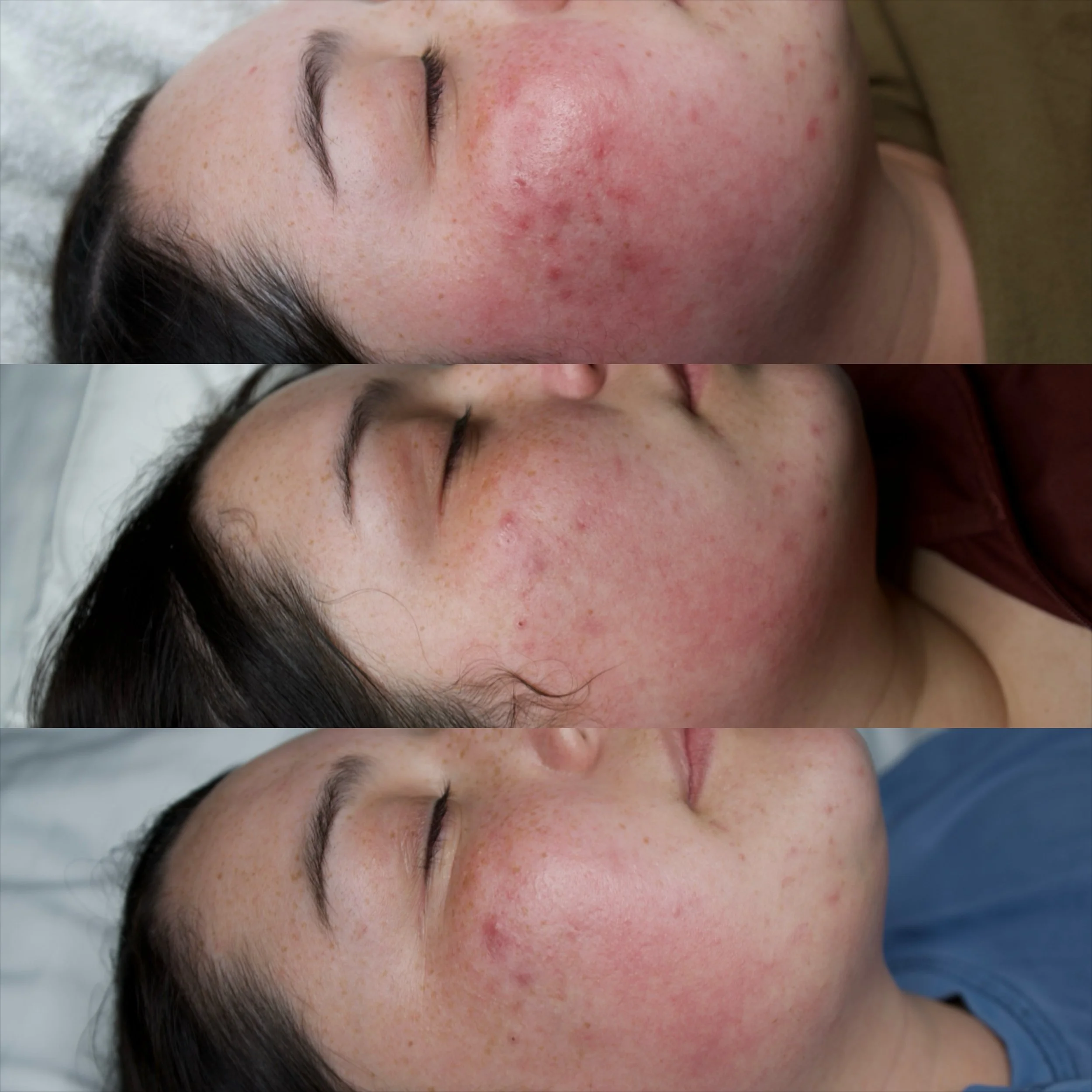 Jet Plasma Treatment Information
