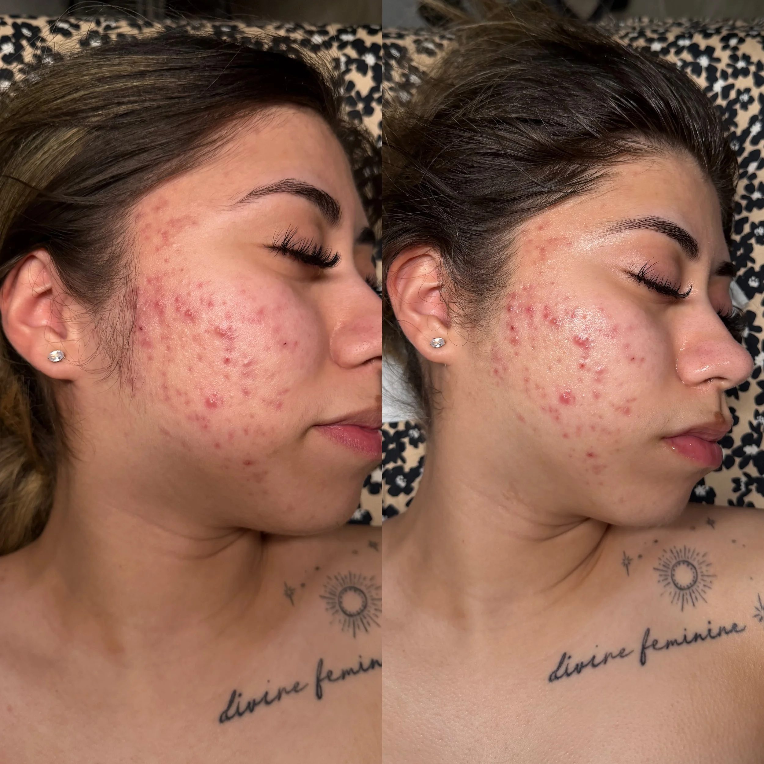 POST INFLAMMATORY ERYTHEMA