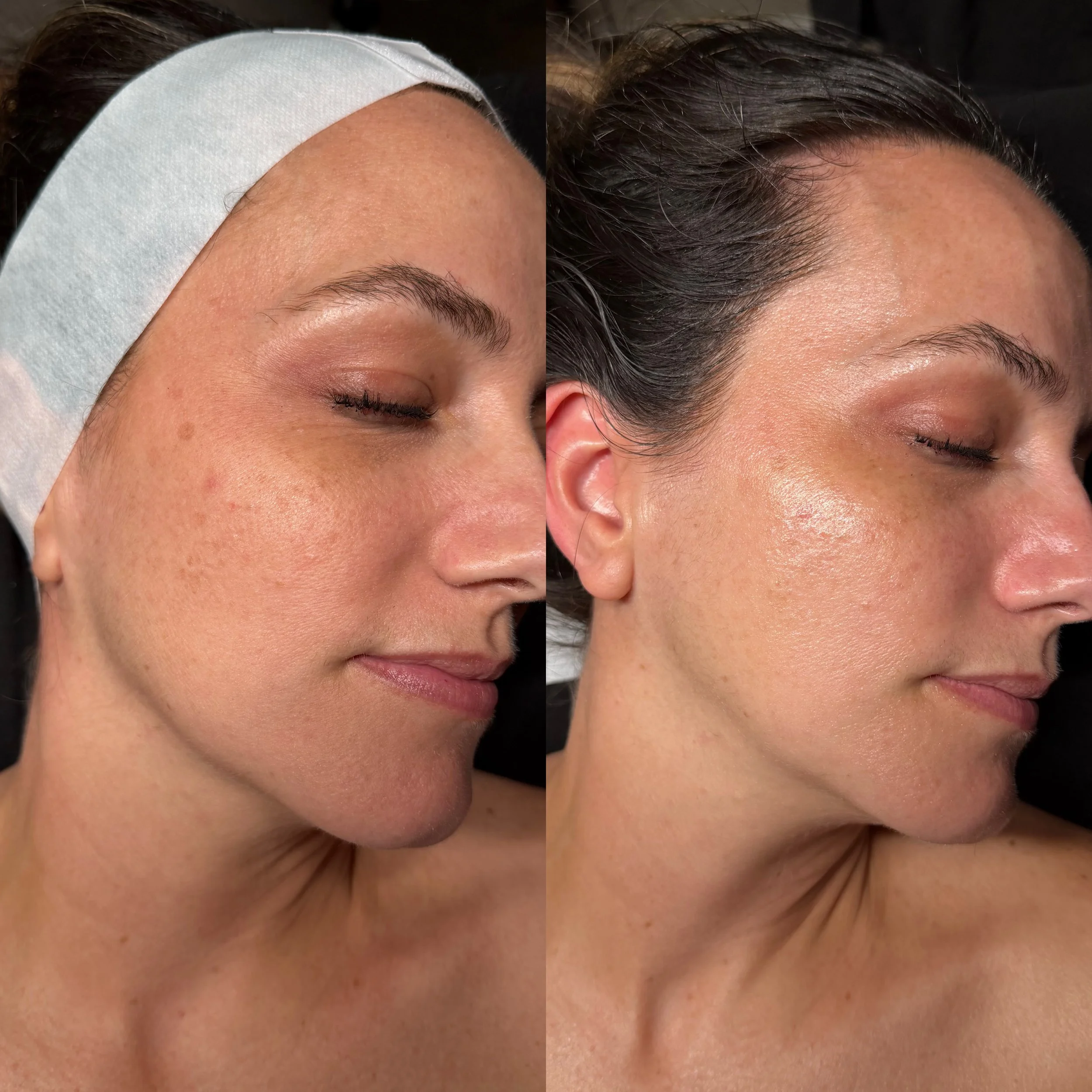 COMPLEXION CORRECTION