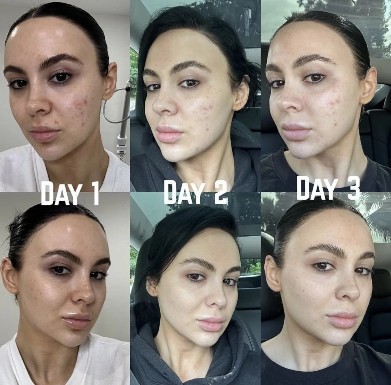 ViPeel collagen project Miami Beach