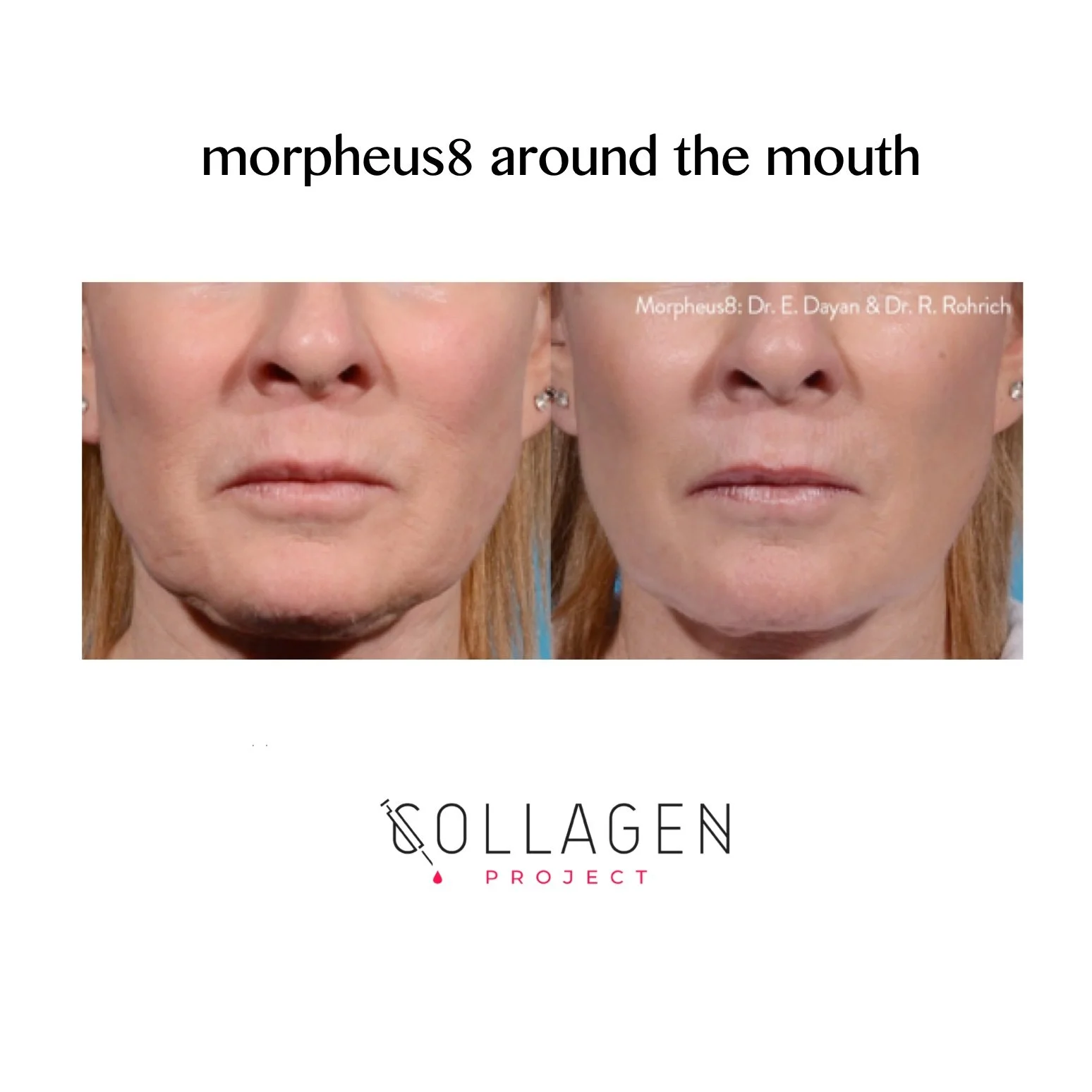 Before and after photos of a woman's face showing skin improvements around the mouth with collagen treatment. Title over the photos reads 'morpheus8 around the mouth.' Logo for 'Collagen Project' at the bottom.