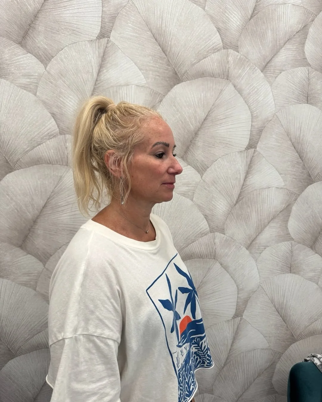 One of the most common questions I get about CoolPeel CO₂ is: &ldquo;What&rsquo;s the downtime?&rdquo; 👀
Here&rsquo;s a look ➡️ before, immediately after, days 1-3.
24-48 hours redness and swelling&mdash; the skin will feel dry like sandpaper for a 