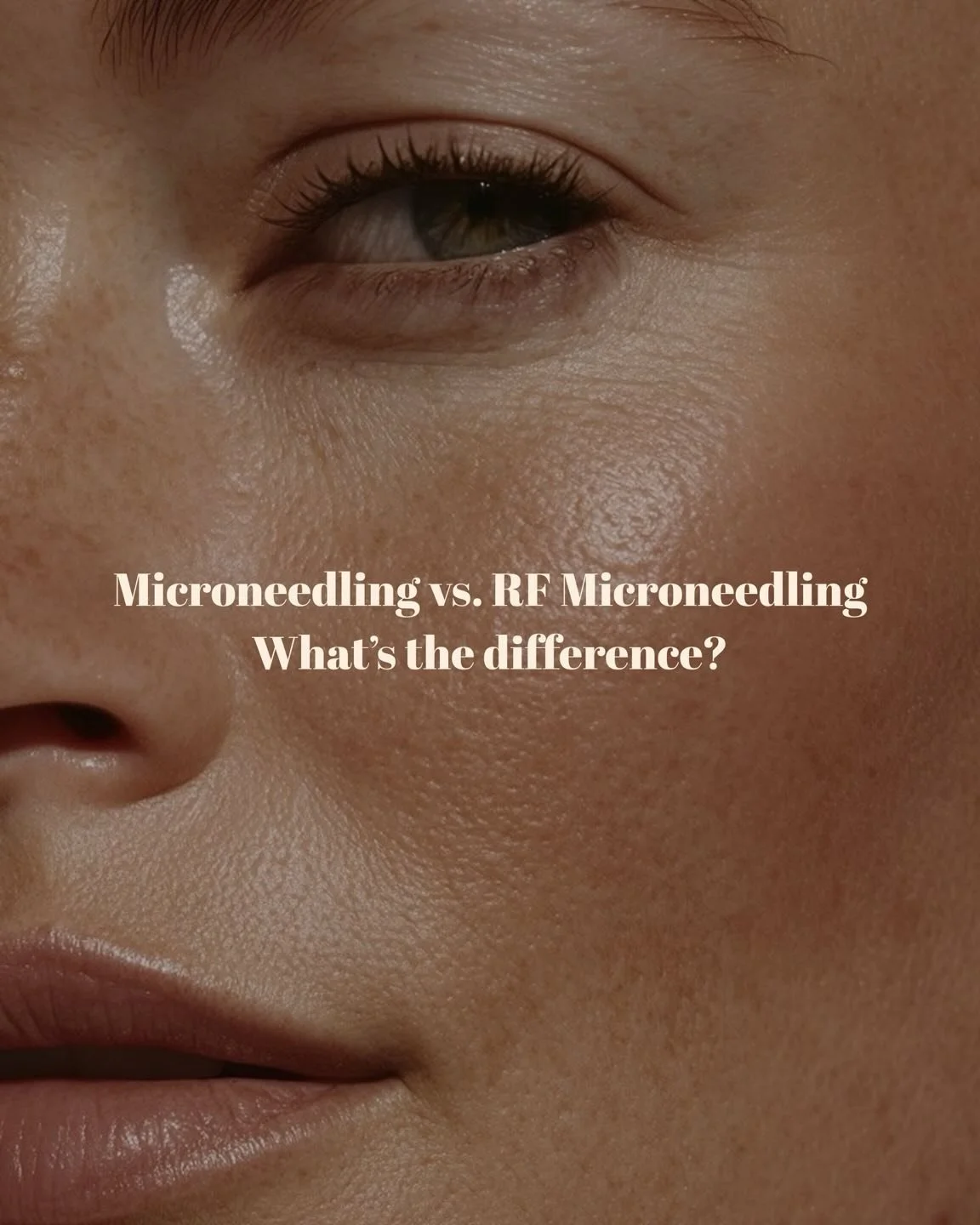 Microneedling vs RF Microneedling &mdash; what&rsquo;s the difference? 👇

✨ Microneedling
&bull; Creates micro-channels to stimulate collagen
&bull; Improves texture, pores &amp; tone
&bull; Enhances product absorption
&bull; Minimal downtime

🔥 RF
