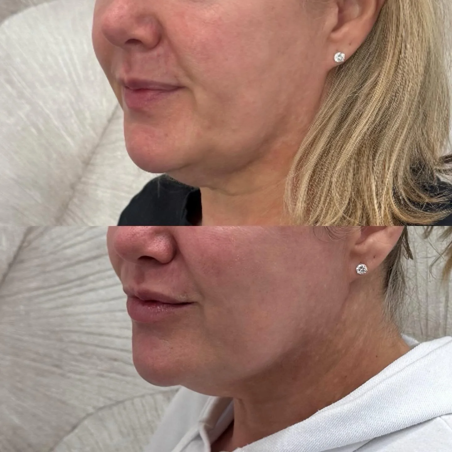Morpheus8 + CoolPeel = full-spectrum collagen remodeling in only one session!

✔️ Reduced jowls
✔️ More defined jawline
✔️ Tighter skin under the chin
✔️ Softer nasolabial folds
✔️ Brighter, smoother, more refined skin texture

Morpheus8 works deep &