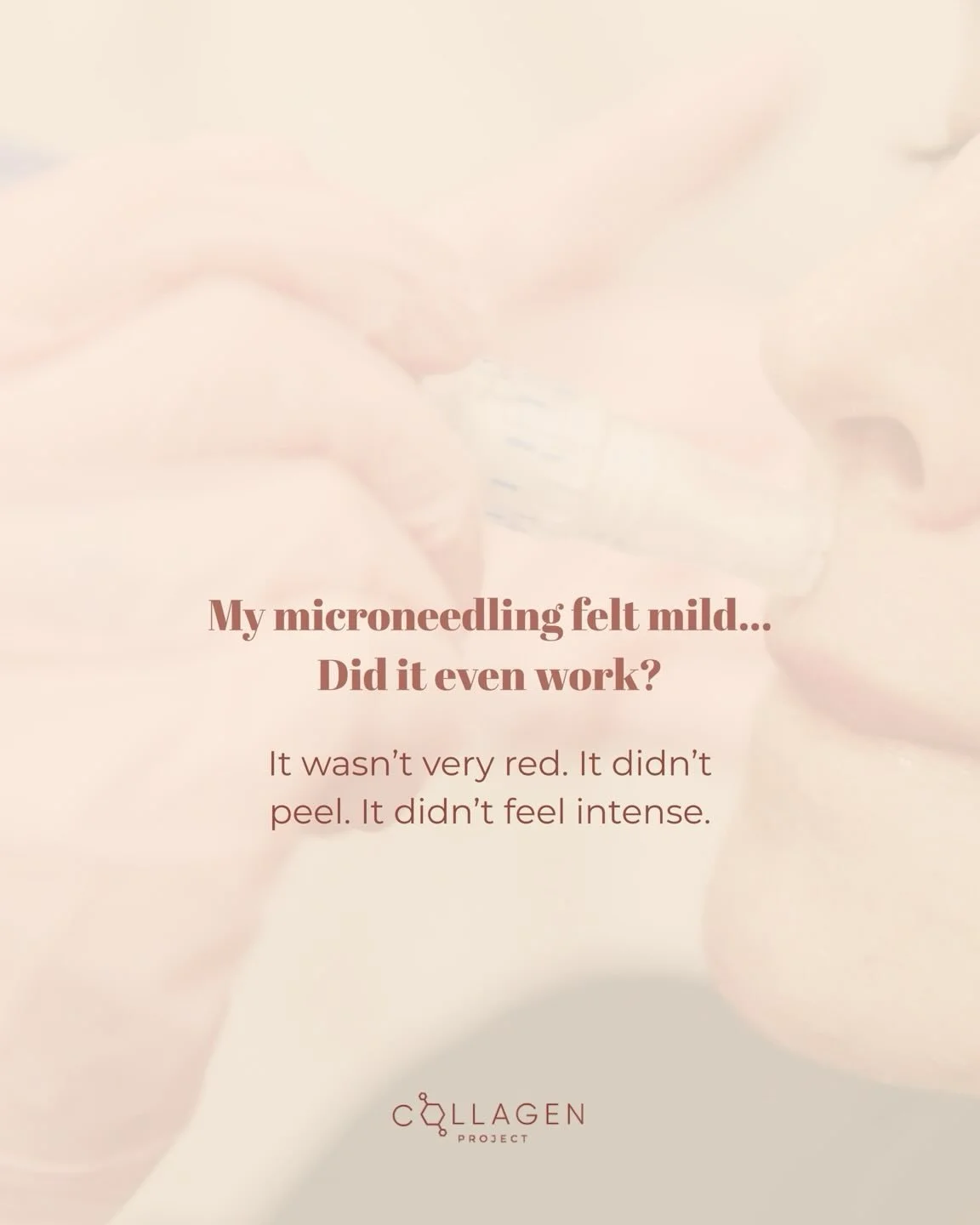 Microneedling works by creating precise, controlled micro-injuries in the skin that stimulate the body&rsquo;s natural repair process. This response triggers new collagen production and increased skin cell turnover, helping improve skin quality, text