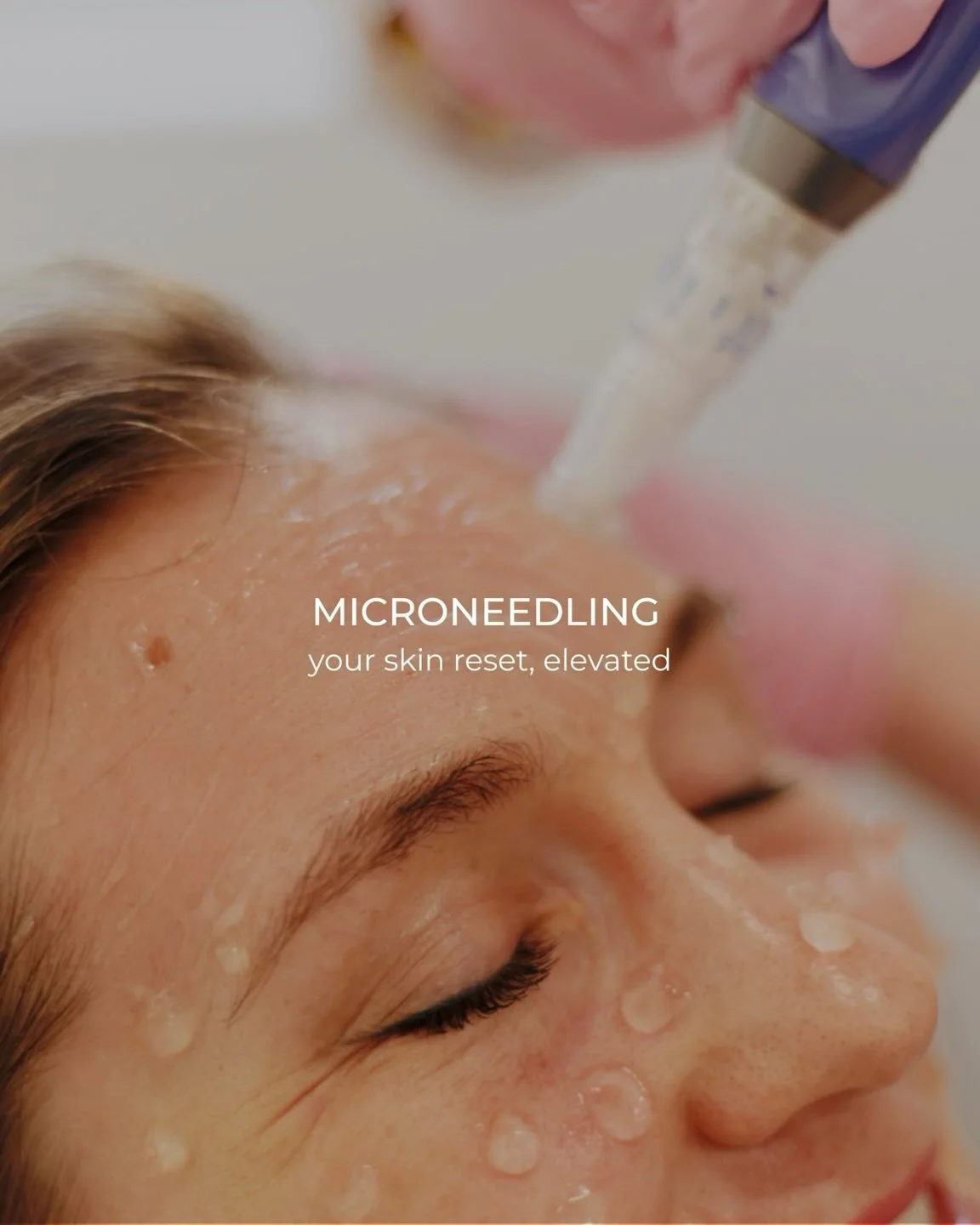 Everything you need to know about microneedling 👇

Your go-to maintenance treatment to stimulate collagen and rebuild what you naturally lose over time. Think stronger, smoother, healthier skin without aggressive downtime.

✨ Boosts collagen + elast