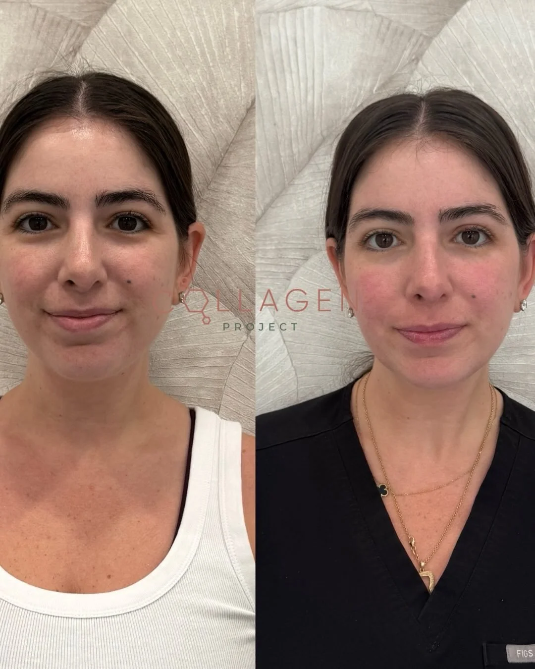 Snatched, but make it soft 🤍

Our NP Vivi @vivithenp has always been self-conscious about fullness under her chin&mdash;so we took a subtle, feminine approach to refining her jawline without changing what makes her her.

After just 1 session of Morp