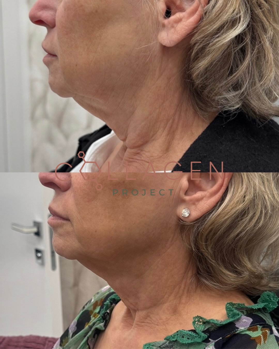 Aging is a privilege. Feeling good in your skin along the way is a choice.

At over 70 years old, after significant weight loss, this patient was left with loose, crepey skin through the neck&mdash;something many people experience but few talk about.