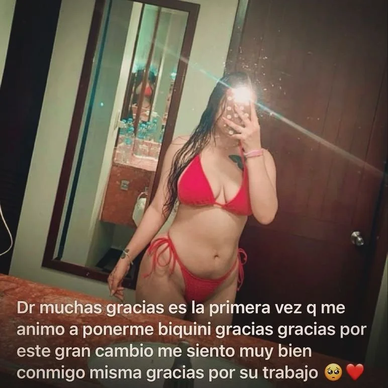 Testimonios reales y sin filtros, una satisfacci&oacute;n leer a mis pacientes felices con sus resultados. Esta es una paciente que tras una Lipoescultura General con infiltraci&oacute;n de grasa en gl&uacute;teos de cuatro meses de evoluci&oacute;n 