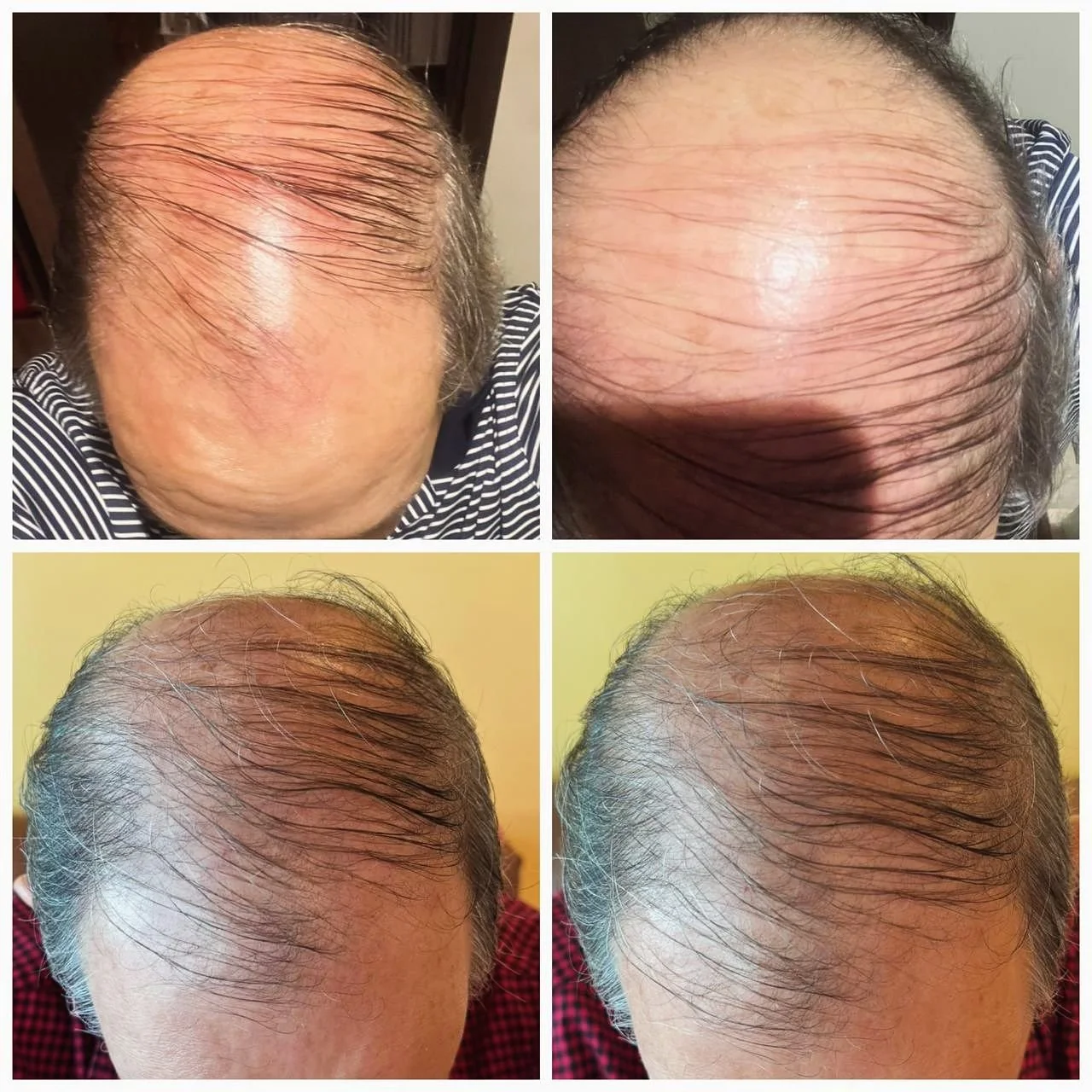 Si sufren de alopecia como yo, o quieren evitar la ca&iacute;da de cabello, quiero compartirles lo siguiente. Ustedes saben que yo no les recomendar&iacute;a cualquier producto a la ligera, por lo que primero que nada lo prob&eacute; en m&iacute; mis