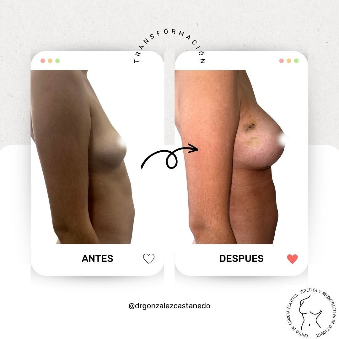 En estas im&aacute;genes puedes ver el asombroso cambio de una de mis pacientes a tan solo dos semanas despu&eacute;s de su cirug&iacute;a de aumento de senos con implantes.

A&uacute;n en semana santa y pascua yo sigo a tus &oacute;rdenes para resol