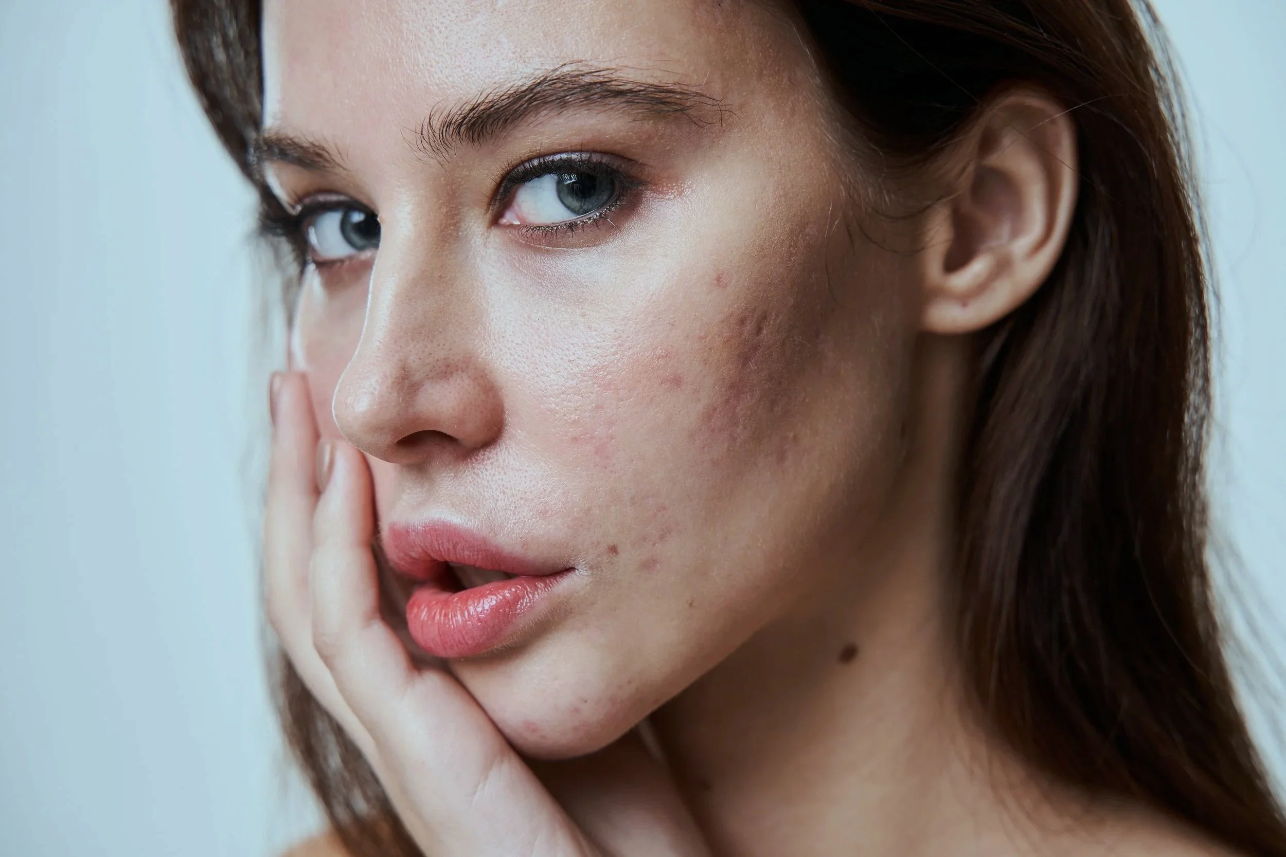 Close-up of a person with visible acne scarring and uneven texture on the cheek, gently touching their face to highlight the concern, representing The Lab Co Toronto’s scar-lightening treatments such as photofacials and targeted facials.