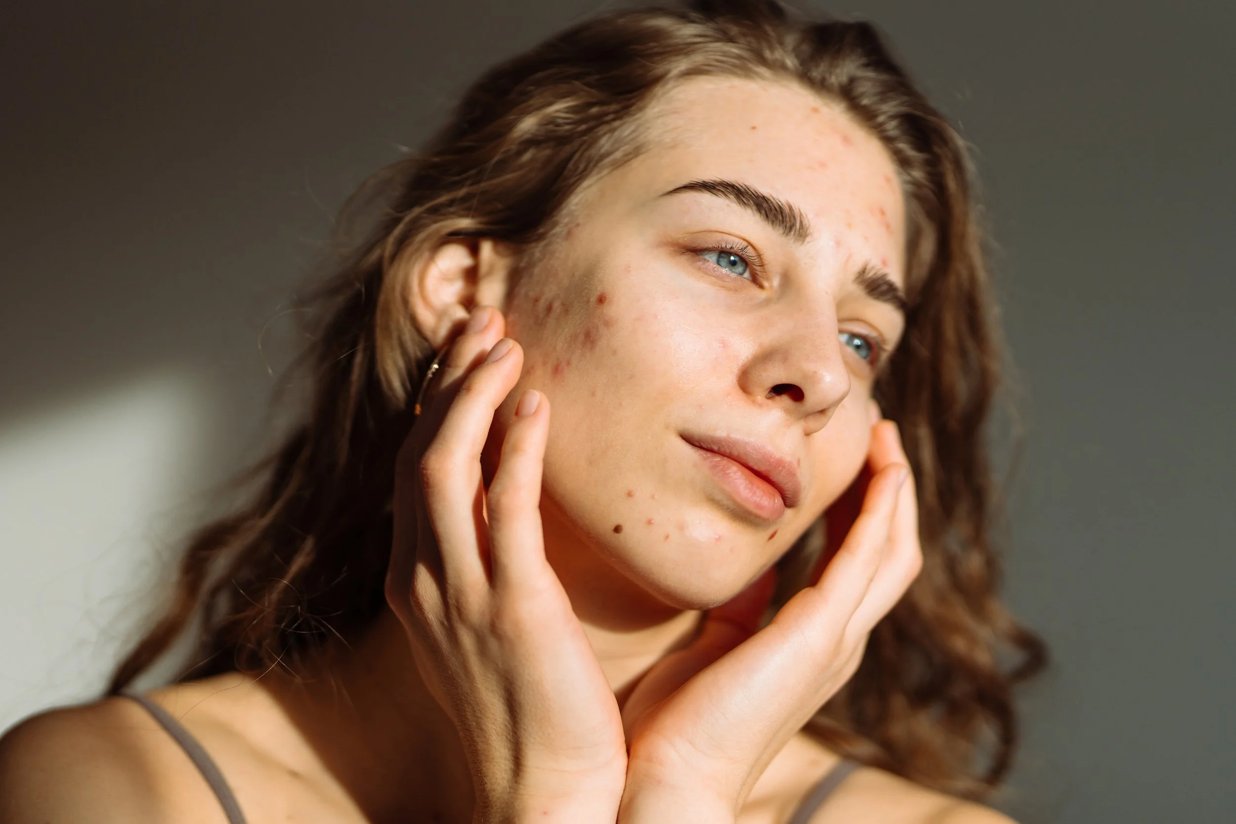 A close-up of a person gently touching their face, showing visible acne and redness along the cheeks and jawline—representing The Lab’s targeted acne treatments designed to calm inflammation, clear breakouts, and support healthier skin.