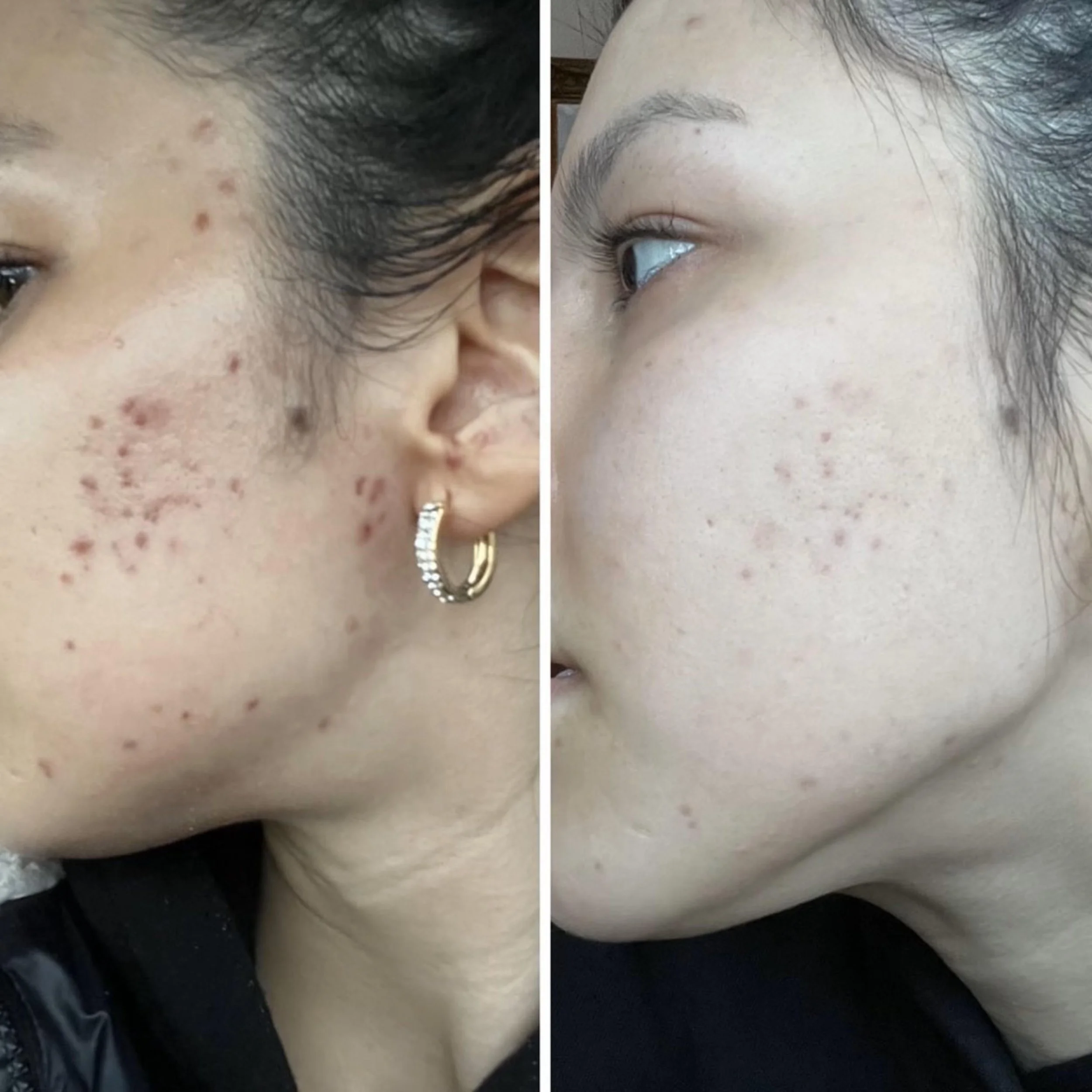 Side-by-side comparison of a person's face showing acne before and after treatment.
